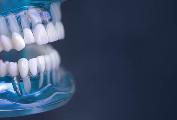 Replace multiple missing teeth with Waukesha dental implants