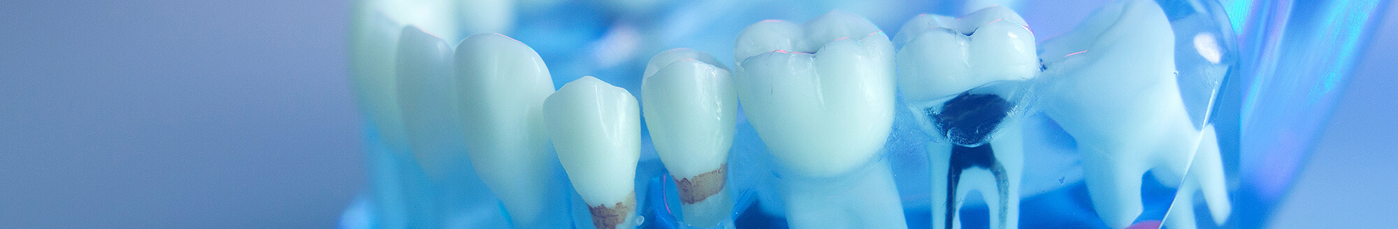 Root Canals for Severely Decayed Teeth - Waukesha & Milwaukee County